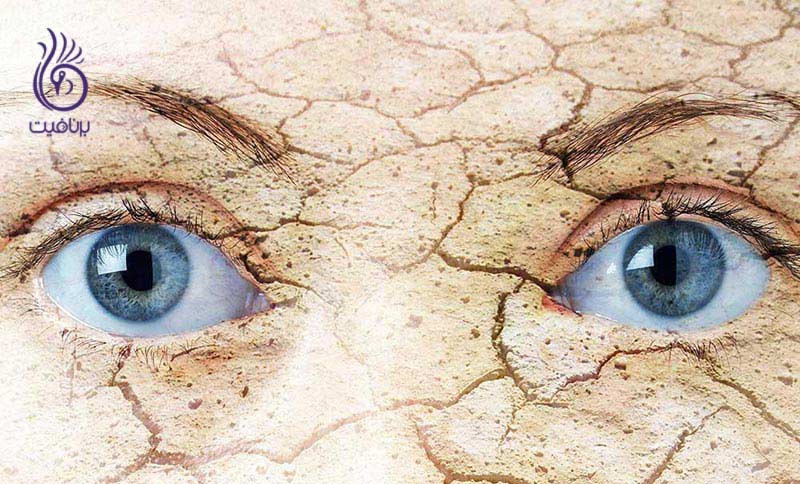 چگونه از خشکی چشم ها جلوگیری کنیم؟ ، برنافیت