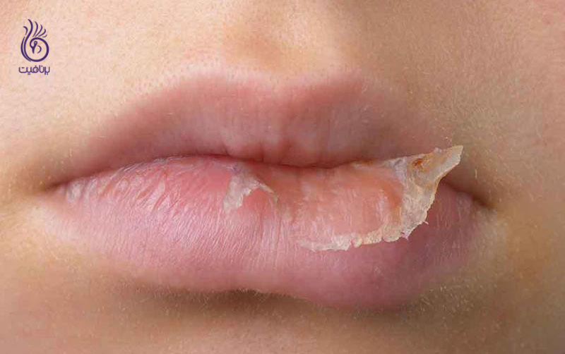 3 ماده ای که موجب التهاب لب های خشک می شود