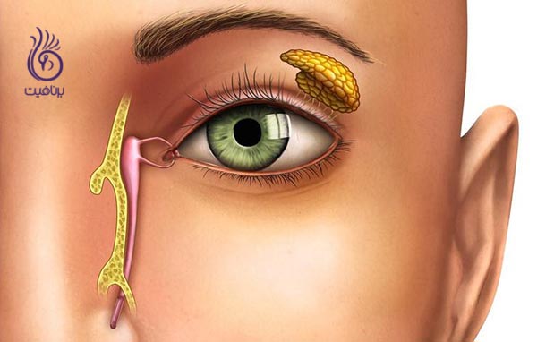 ترشحات زرد رنگ گوشه ی چشم نشانه ی چیست؟