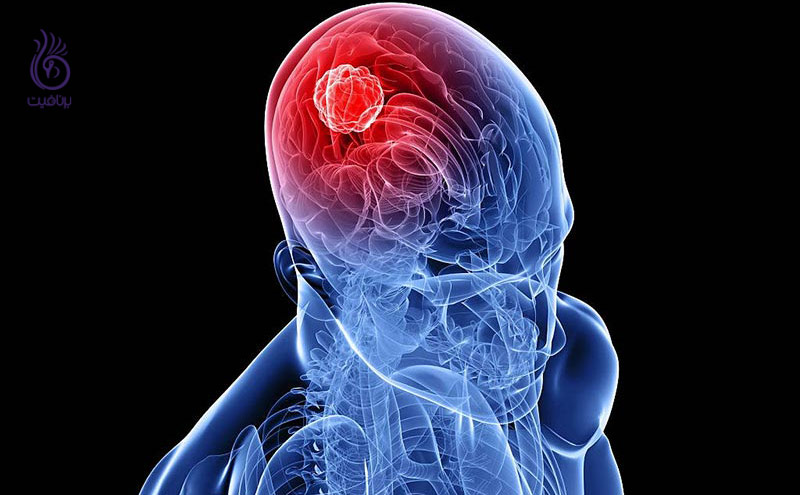 علائم هشدار دهنده ی تومور مغزی ، برنافیت