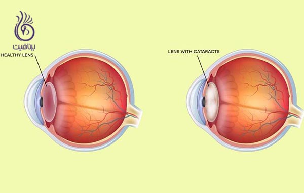 5 بیماری چشمی که نباید نادیده بگیرید