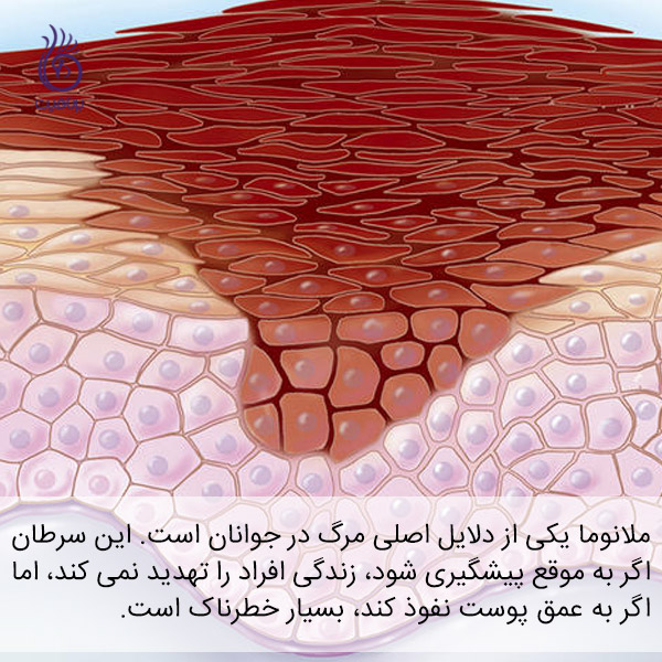 سرطان پوست - ملانوما - برنافیت
