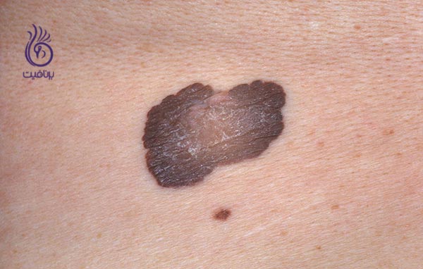 سرطان پوست - خال - برنافیت