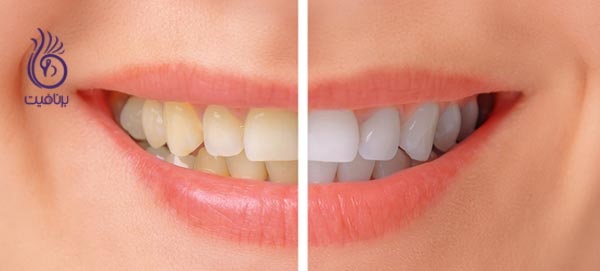 این 7 قدم دندان های شما را زیباتر می کنند - سفید کردن دندان - برنافیت