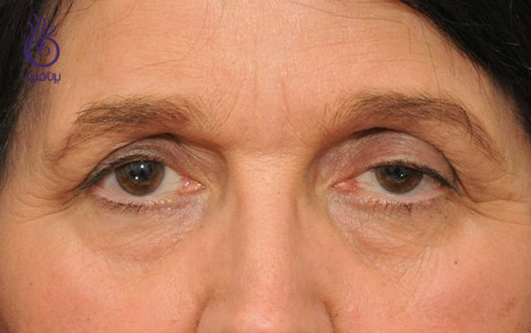 درمان افتادگی پلک با rf- زیبایی- برنافیت