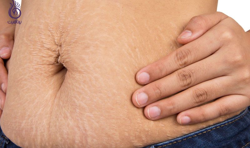 رفع ترک های پوستی- میکرونیدلینگ- برنافیت