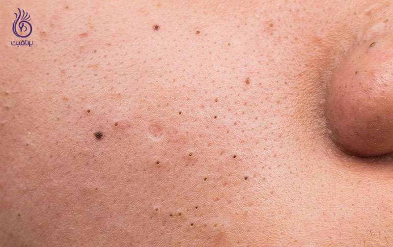 جوش های سرسیاه- زیبایی- برنافیت