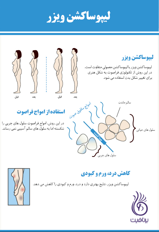 تاثیرگذاری دستگاه لاغری موضعی کویتیشن چگونه است؟