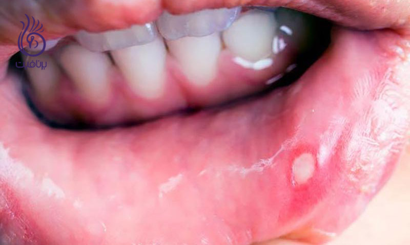 آفت دهان را به روش طبیعی درمان کنید ، برنافیت