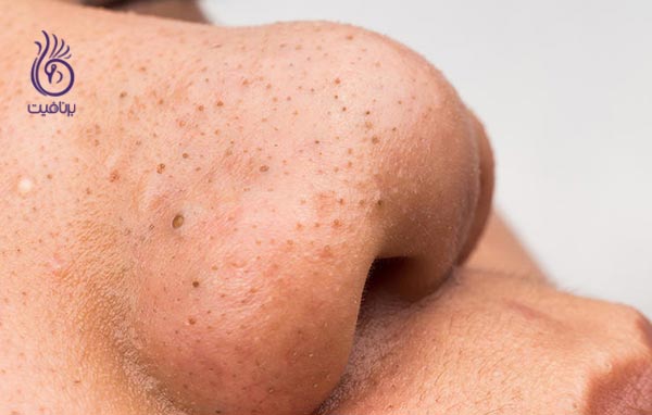 درمان خانگی برای مشکلات پوستی - جوش سر سیاه - برنافیت