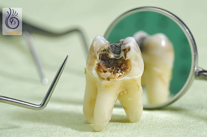 جلوگیری از خرابی دندان