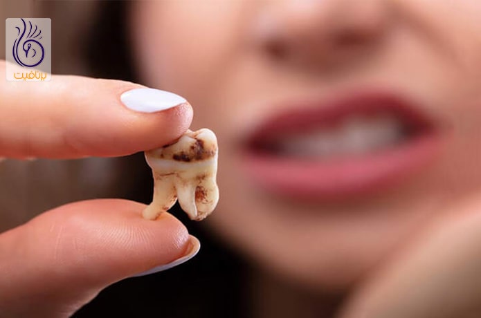 پوسیدگی دندان و رژیم خام گیاهخواری
