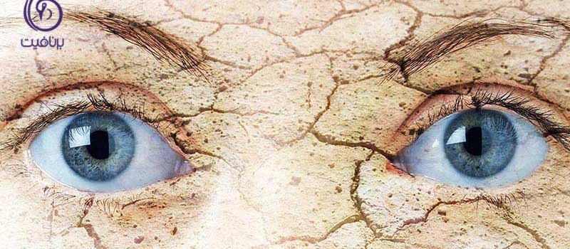 چگونه از خشکی چشم ها جلوگیری کنیم؟ ، برنافیت