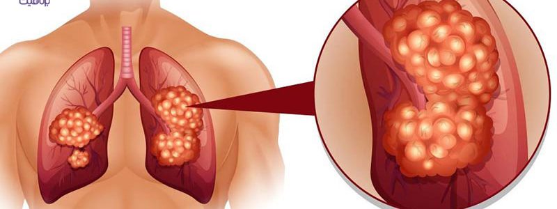 علائم عجیب و غریب سرطان ریه را بشناسید