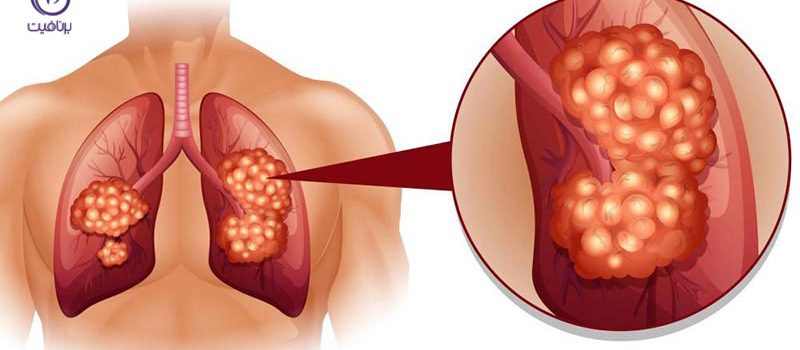 علائم عجیب و غریب سرطان ریه را بشناسید