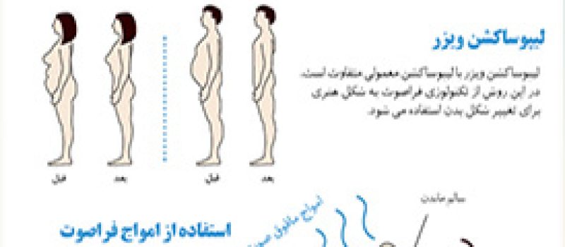 لیپوساکشن ویزر ، برنافیت